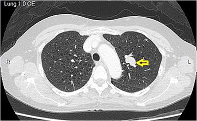 Uniportal video-assisted thoracoscopic segmentectomy for fetal adenocarcinoma lung cancer with severe pulmonary emphysema: a case report